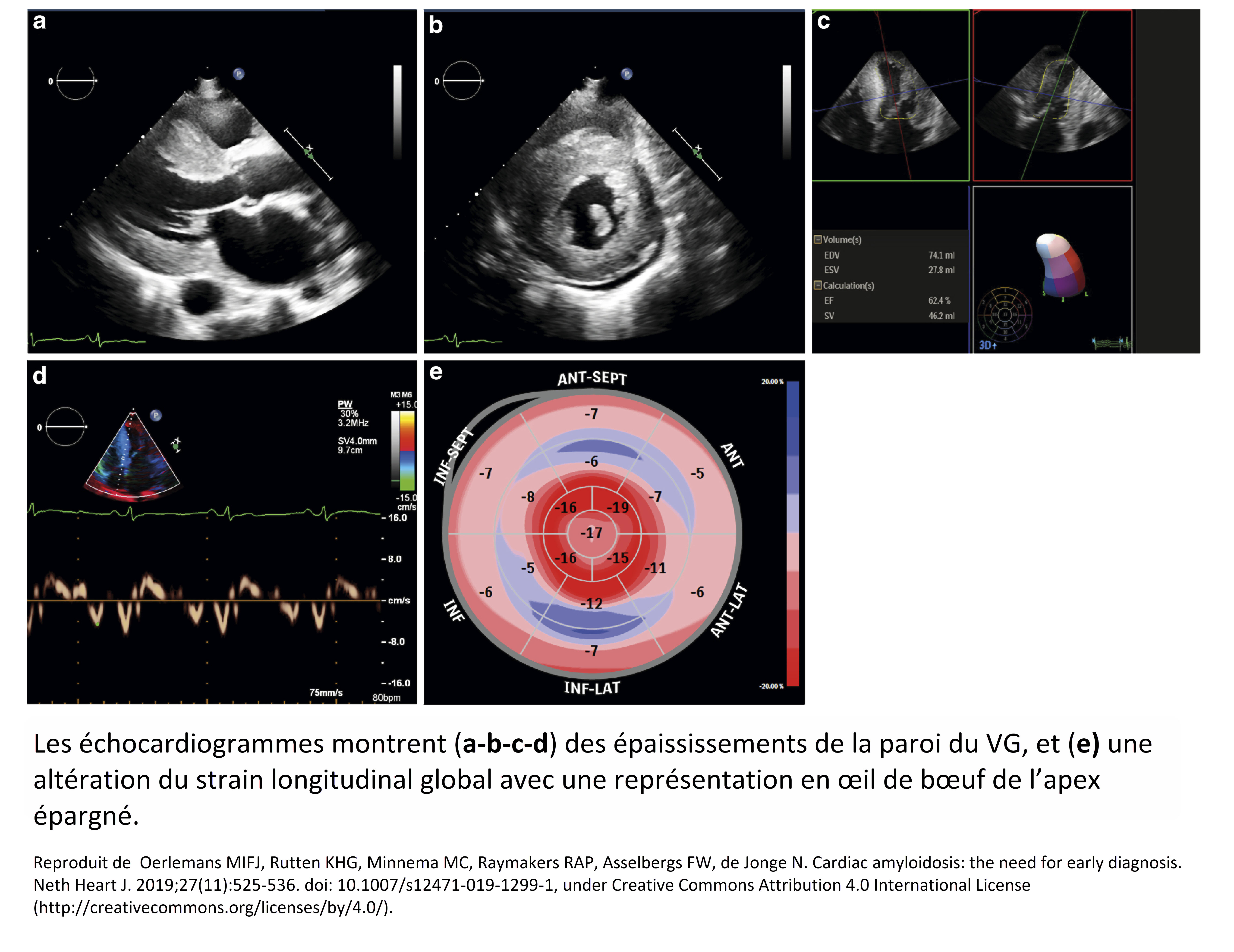 Les échocardiogrammes montrent des épaississements de la paroi du VG, et une altération du strain longitudinal global