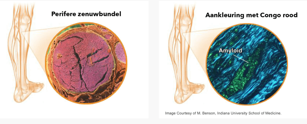 Een Congorood kleuring die een appelgroen beeld geeft onder gepolariseerd licht is indicatief voor amyloïd.