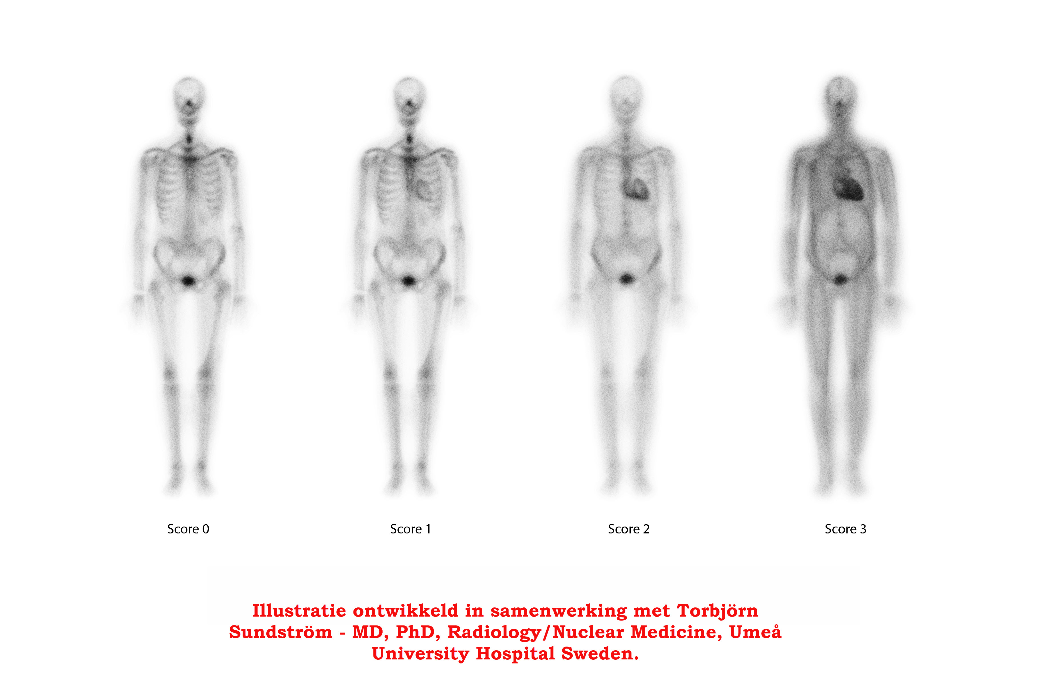 De rol van botscintigrafie om ATTR cardiomyopathie te detecteren.