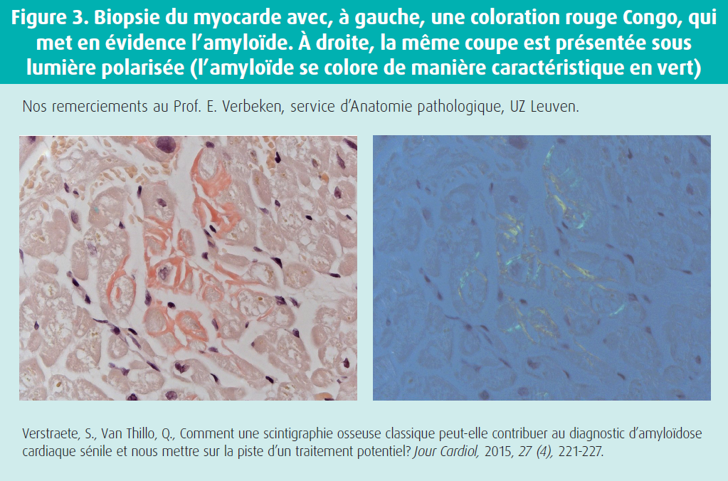 La biopsie endomyocardique avec coloration au rouge Congo reste recommandée pour confirmer le diagnostic d'une ATTR-CM