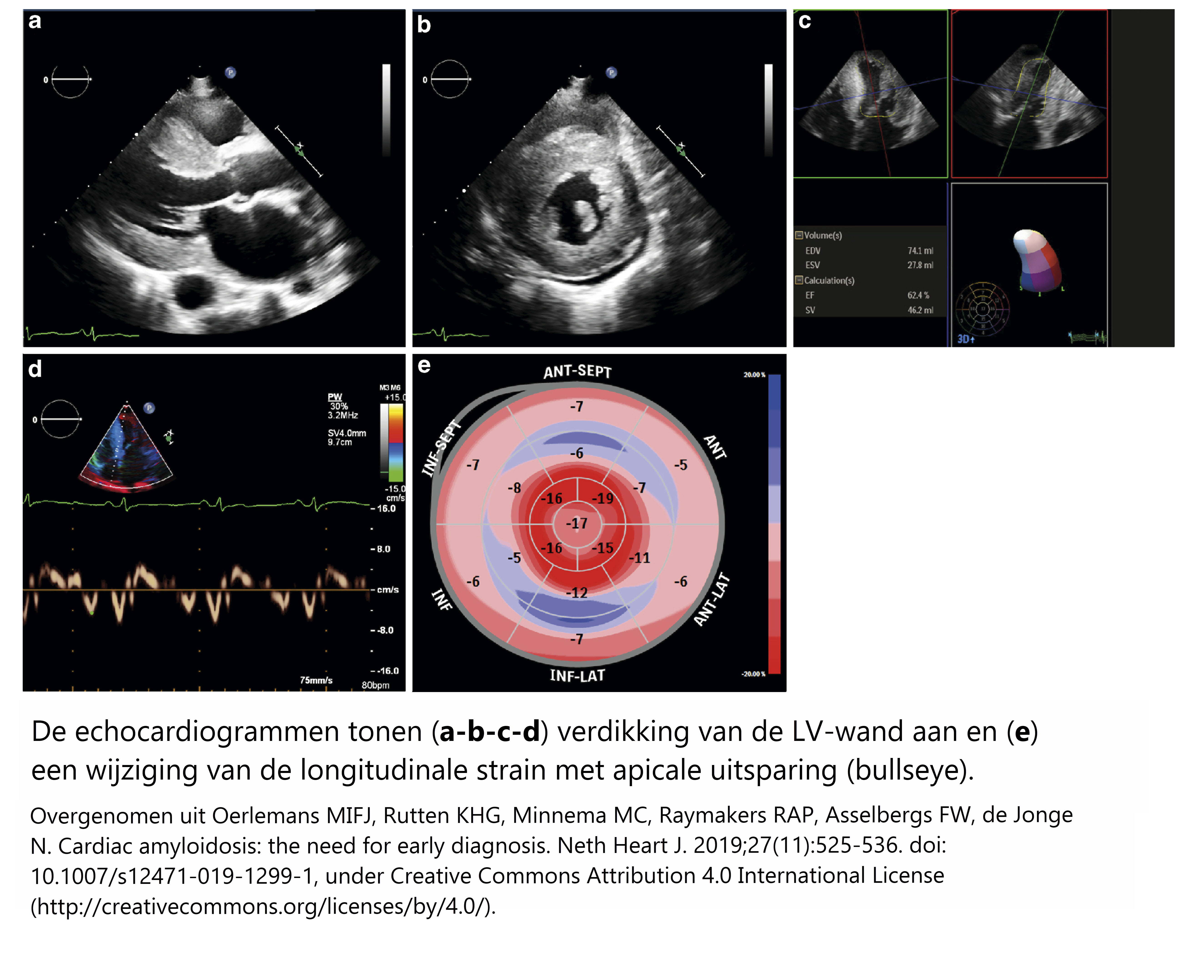 De echocardiogrammen tonen verdikking van de LV-wand aan en een wijziging van de longitudinale strain met apicale uitsparing